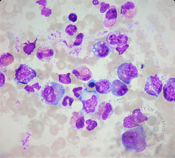 Bone marrow aspirate