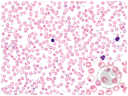Hemoglobin Southampton (Casper) inclusions resembling intracellular parasites