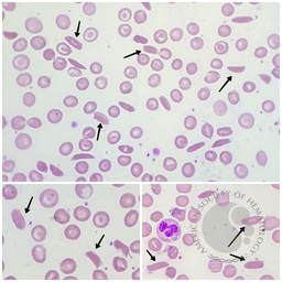 Hemoglobin C Crystals