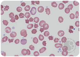 Acanthocytosis: a key feature for the diagnosis of abetalipoproteinemia