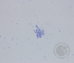CSF Pseudomonas aeruginosa and Enterobacter cloacae