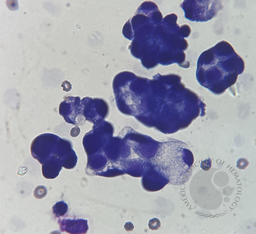 Malignant Pleural Effusion 1