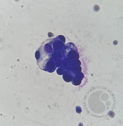 Malignant Pleural Effusion 2