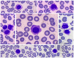 Hairy Cell Leukemia