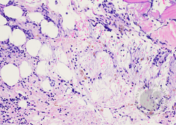 Bone marrow biopsy - H&E (low power)
