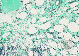 Bone marrow biopsy - GMS