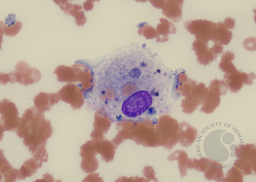 Macrophage with engulfed RBCs and cell debris