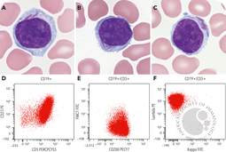 Auer rod–like inclusions in chronic lymphocytic leukemia