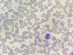 Hereditory Elliptocytosis- Peripheral smear image(100x)showing more than 30% of elliptical shaped RBCs.