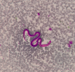 Peripheral blood smear showing microfilaria, Giemsa stain