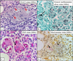 Disseminated cryptococcal infection in a recently diagnosed acquired immunodeficiency syndrome