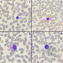 Reactive lymphocyte types