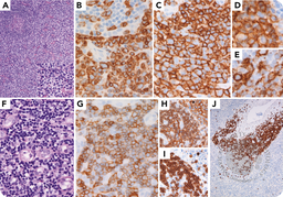 Peripheral T-cell lymphoma with TFH phenotype and associated indolent T-lymphoblastic proliferation