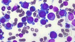 Acute erythroid leukemia