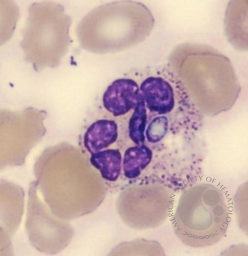 Histoplasma capsulatum in peripheral blood smear