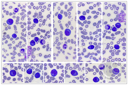 Plasmacytoid Lymphocytes in Chickenpox