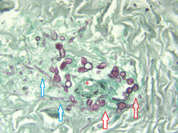 Skin Biopsy 1) Gomori’s methenamine silver; 400x