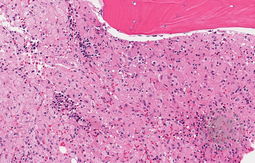 Bone marrow involvement by Gaucher's disease.