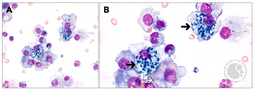 Pulmonary hemosiderin-laden macrophages