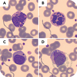 Diagnostic peripheral blood smear for Chédiak-Higashi syndrome in a 43-month-old boy, confirmed by sequencing