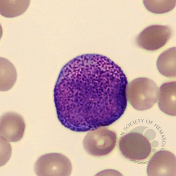 Hypergranular promyelocytes