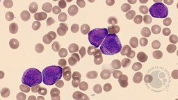 Blood smear with hypergranular blasts