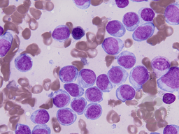 Blastic Plasmacytoid Dendritic Cell Neoplasm 6