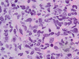 Blastic Plasmacytoid Dendritic Cell Neoplasm 7