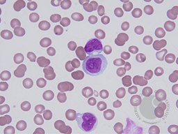 Blastic Plasmacytoid Dendritic Cell Neoplasm 10
