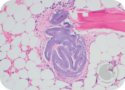 Hydrophilic polymer embolus in the bone marrow