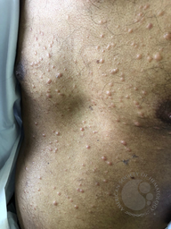 Leukemia cutis 1