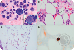 Unexpected parvovirus B19 infection in a patient with multiple myeloma