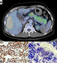 Hepatic Plasmacytoma