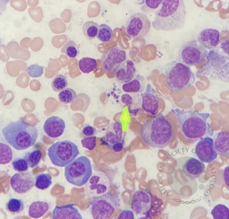 Leishmania amastigotes in the bone marrow 1