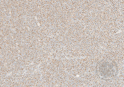Tumor Biopsy 2