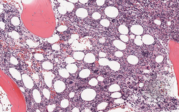 Bone Marrow Biopsy 1
