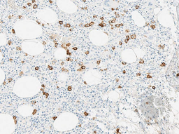 Bone Marrow Biopsy 2