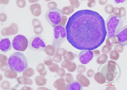 Parvovirus B19 infection 1