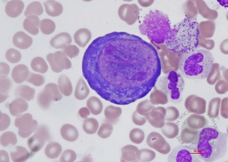 Parvovirus B19 infection 4