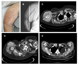 Unveiling Multiple Myeloma Through a Bulky Humerus Plasmacytoma