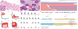 Acute leukemia with predominantly myeloid differentiation and TBL1XR1::CSF1R fusion