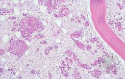 SCC in Bone Marrow 1