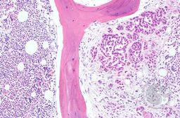 SCC in Bone Marrow 2