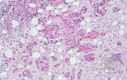 SCC in Bone Marrow 3