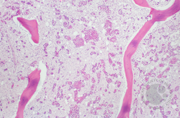 SCC in Bone Marrow 4