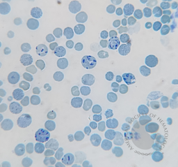 Hemoglobin H disease (HbH) 2
