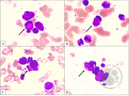 LE cells in the marrow – A subtle indicator of systemic lupus erythematosus in a clinically unforeseen case