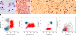T/myeloid MPAL with biallelic CEBPA mutations