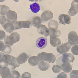 Pseudo Pelger-Huet cell