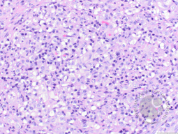 ALCL, lymphohistiocytic variant